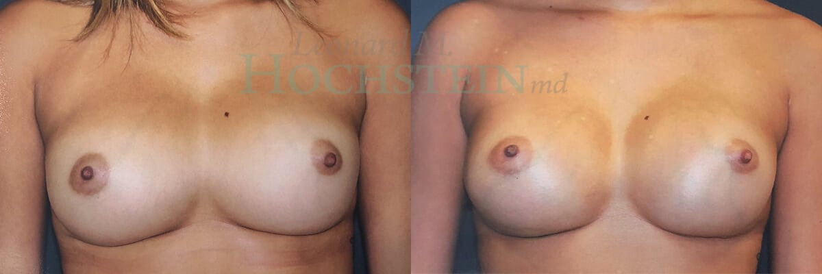 Breast Revision Patient