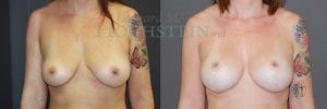 Breast Lift With Implants Patient