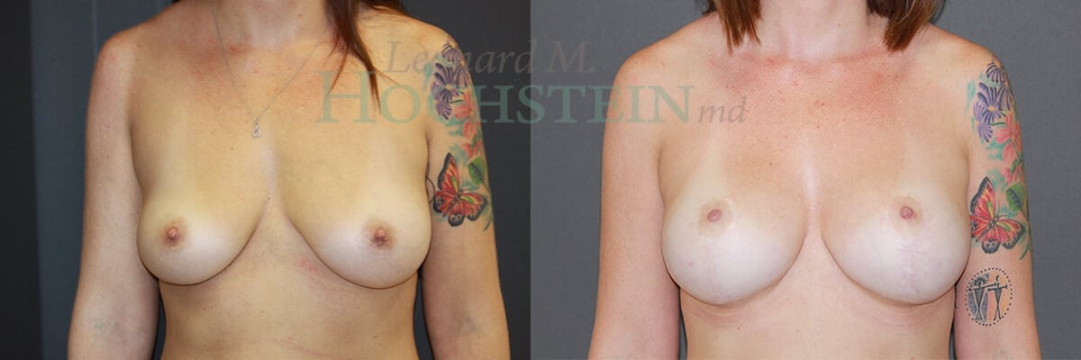 Breast Lift With Implants Patient