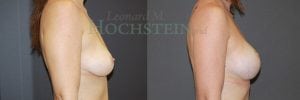 Breast Lift With Implants Patient