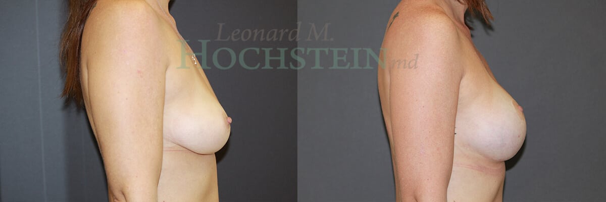 Breast Lift With Implants Patient