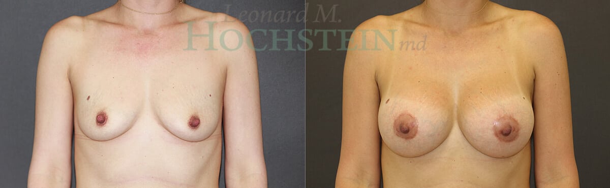 Breast Lift With Implants Patient