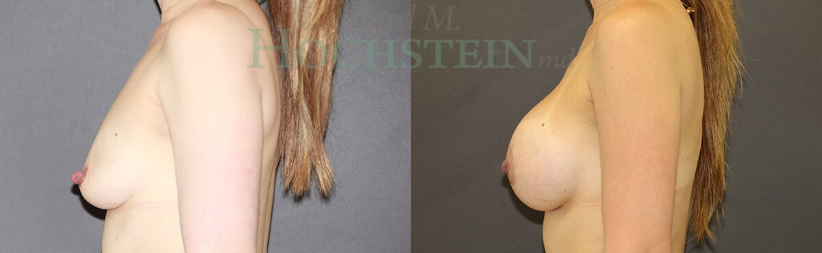 Breast Lift With Implants Patient