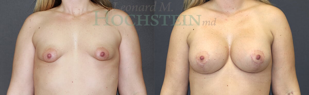 Breast Lift With Implants Patient