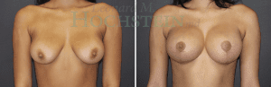 Breast Lift With Implants Patient
