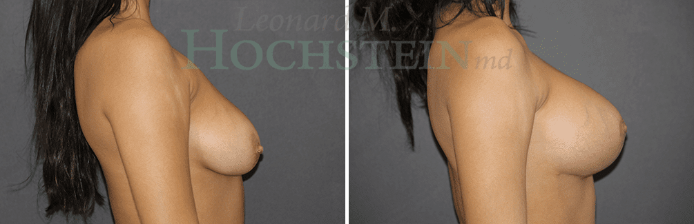 Breast Lift With Implants Patient