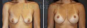 Breast Lift With Implants Patient