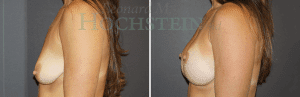 Breast Lift With Implants Patient