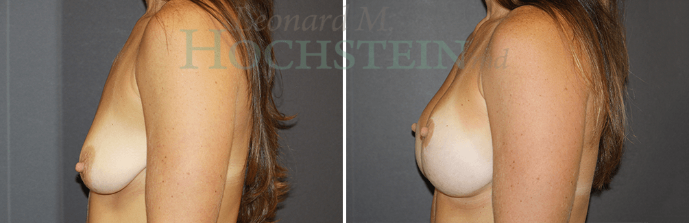 Breast Lift With Implants Patient