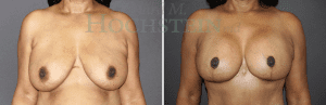 Breast Lift With Implants Patient