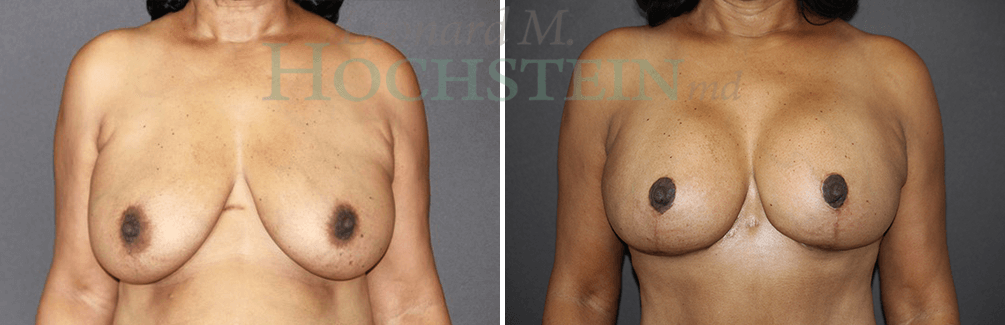 Breast Lift With Implants Patient