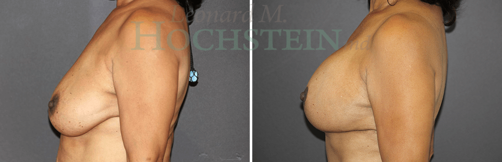 Breast Lift With Implants Patient