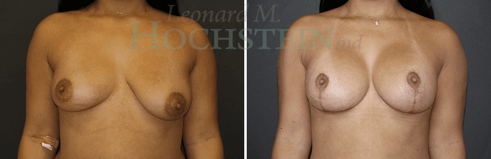 Breast Lift With Implants Patient