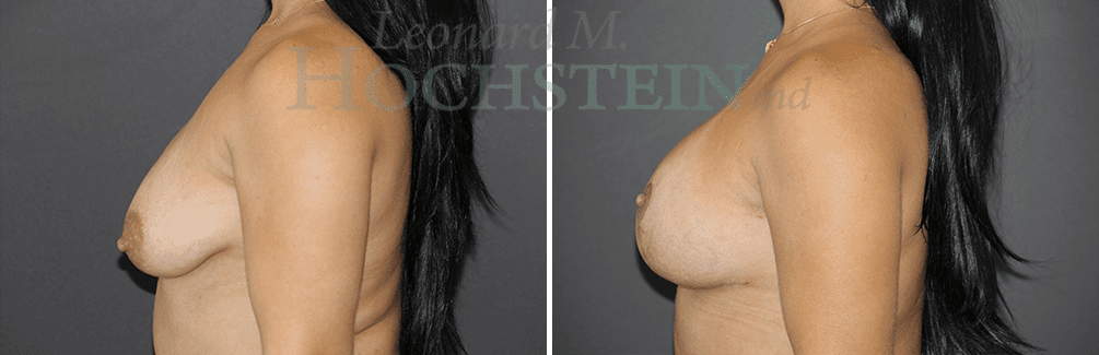 Breast Lift With Implants Patient