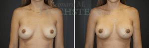 Breast Lift With Implants Patient
