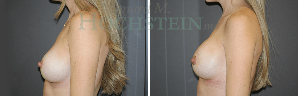 Breast Lift With Implants Patient