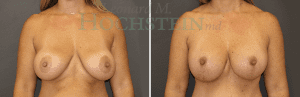 Breast Lift With Implants Patient