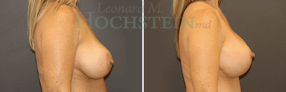 Breast Lift With Implants Patient