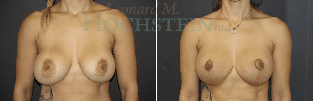 Breast Lift With Implants Patient