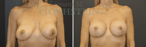 Breast Lift With Implants Patient