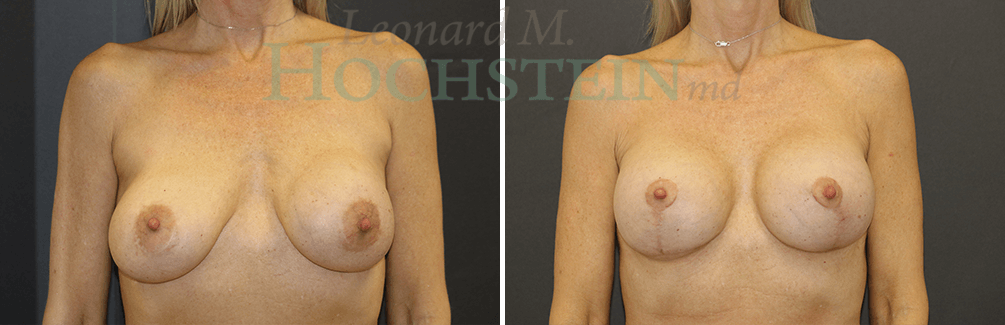Breast Lift With Implants Patient