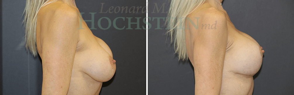 Breast Lift With Implants Patient