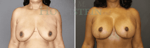 Breast Lift With Implants Patient