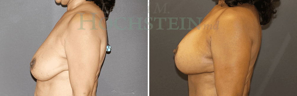 Breast Lift With Implants Patient