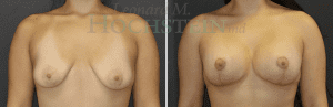 Breast Lift Patient 179