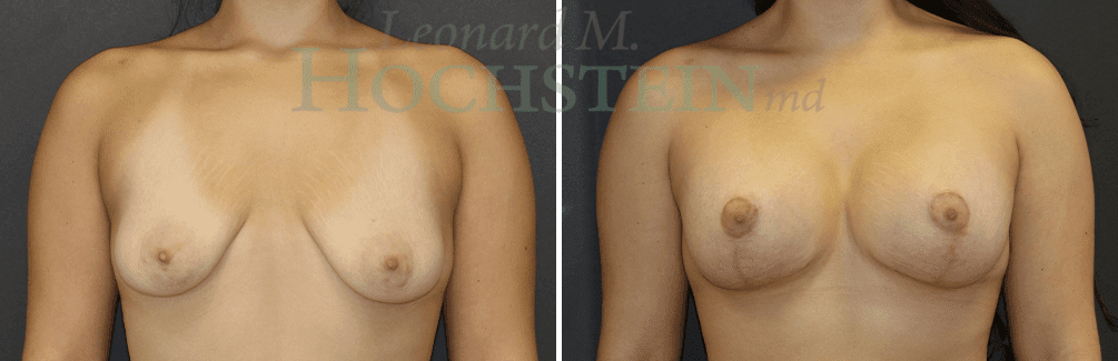 Breast Lift With Implants Patient