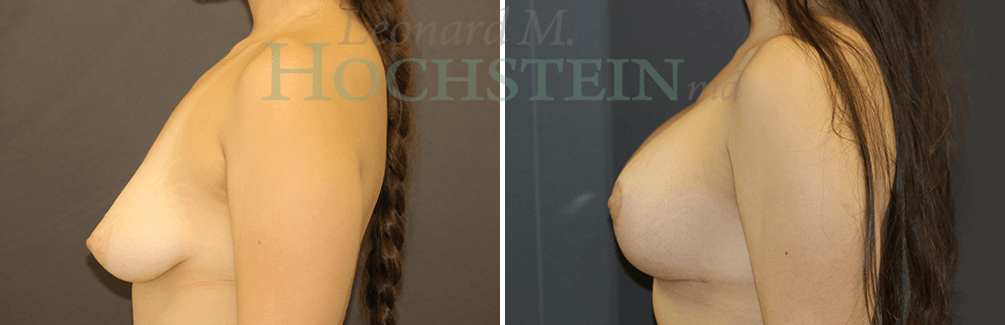 Breast Lift With Implants Patient