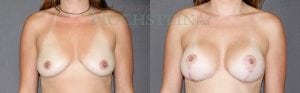 Breast Lift With Implants Patient