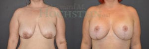 Breast Lift With Implants Patient
