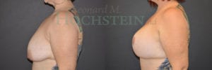 Breast Lift With Implants Patient