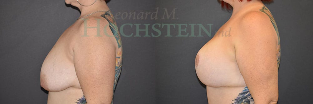 Breast Lift With Implants Patient