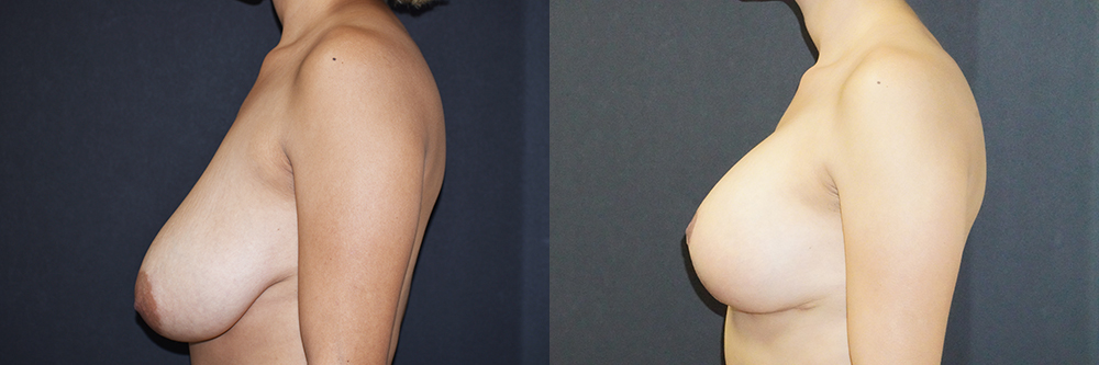Breast Lift With Implants Patient