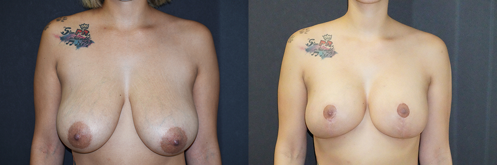 Breast Lift With Implants Patient