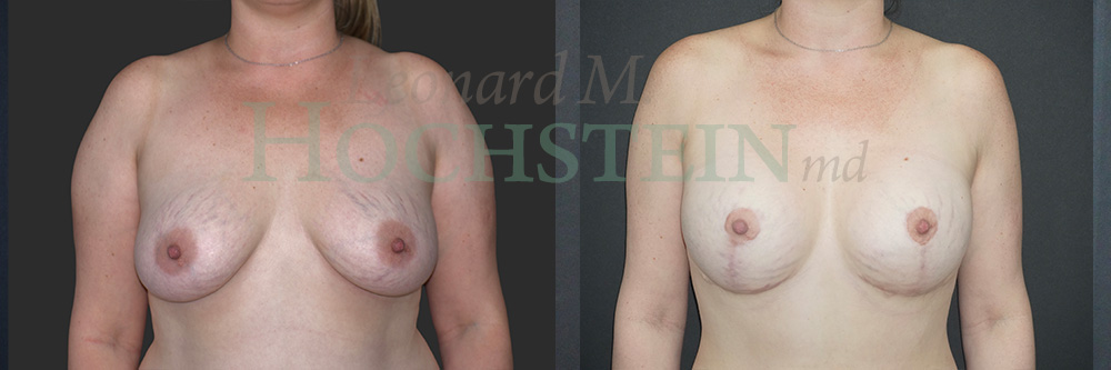 Breast Lift With Implants Patient