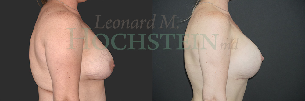 Breast Lift With Implants Patient