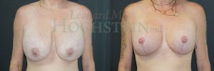 Breast Lift Patient 193