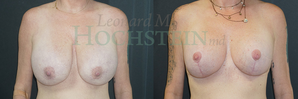 Breast Lift With Implants Patient
