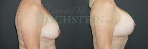 Breast Lift With Implants Patient
