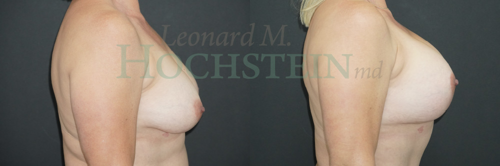 Breast Lift With Implants Patient