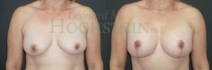 Breast Lift With Implants Patient