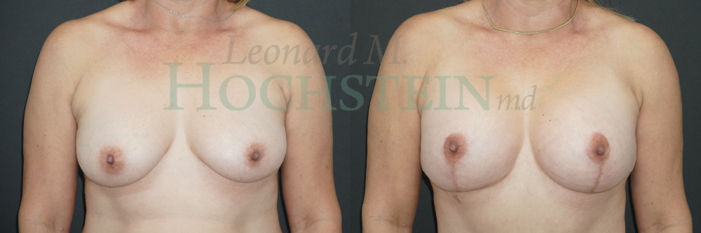 Breast Lift With Implants Patient