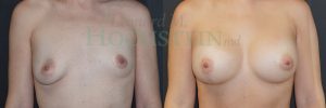 Breast Lift Patient 197