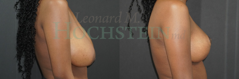 Breast Lift With Implants Patient