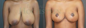 Breast Lift With Implants Patient