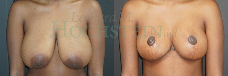 Breast Lift With Implants Patient