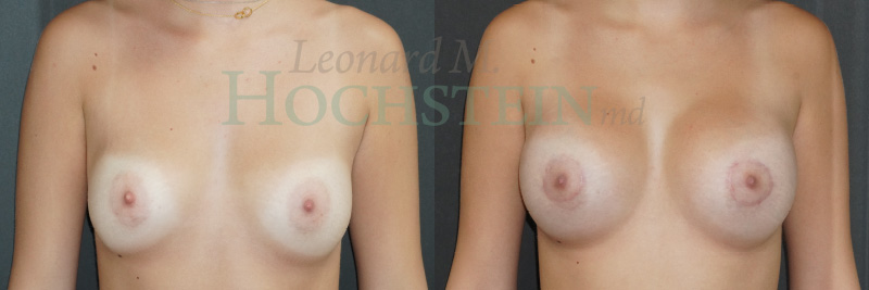 Breast Lift With Implants Patient